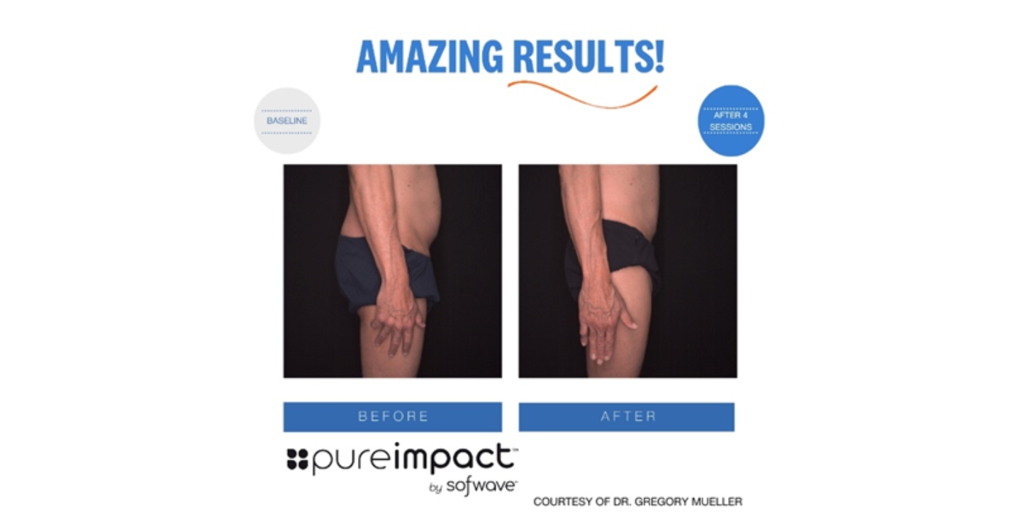A man before and after Pure Impact treatment