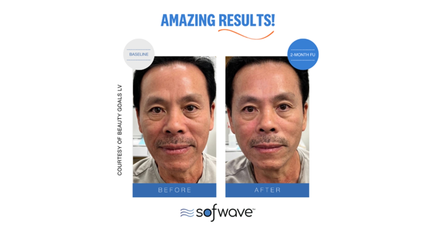 A man before and after Sofwave treatment