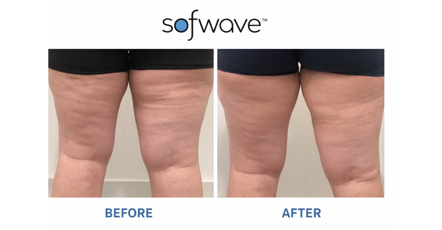 Ozempic legs before and after