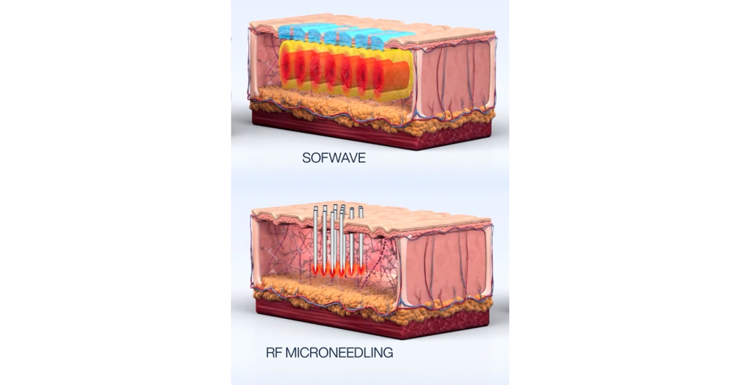 Sofwave vs microneedling