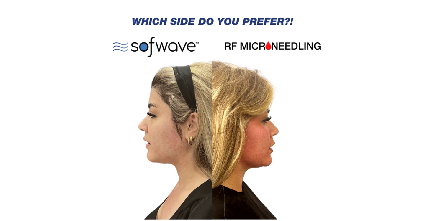 Patient right after Sofwave treatment vs same patient after microneedling procedure
