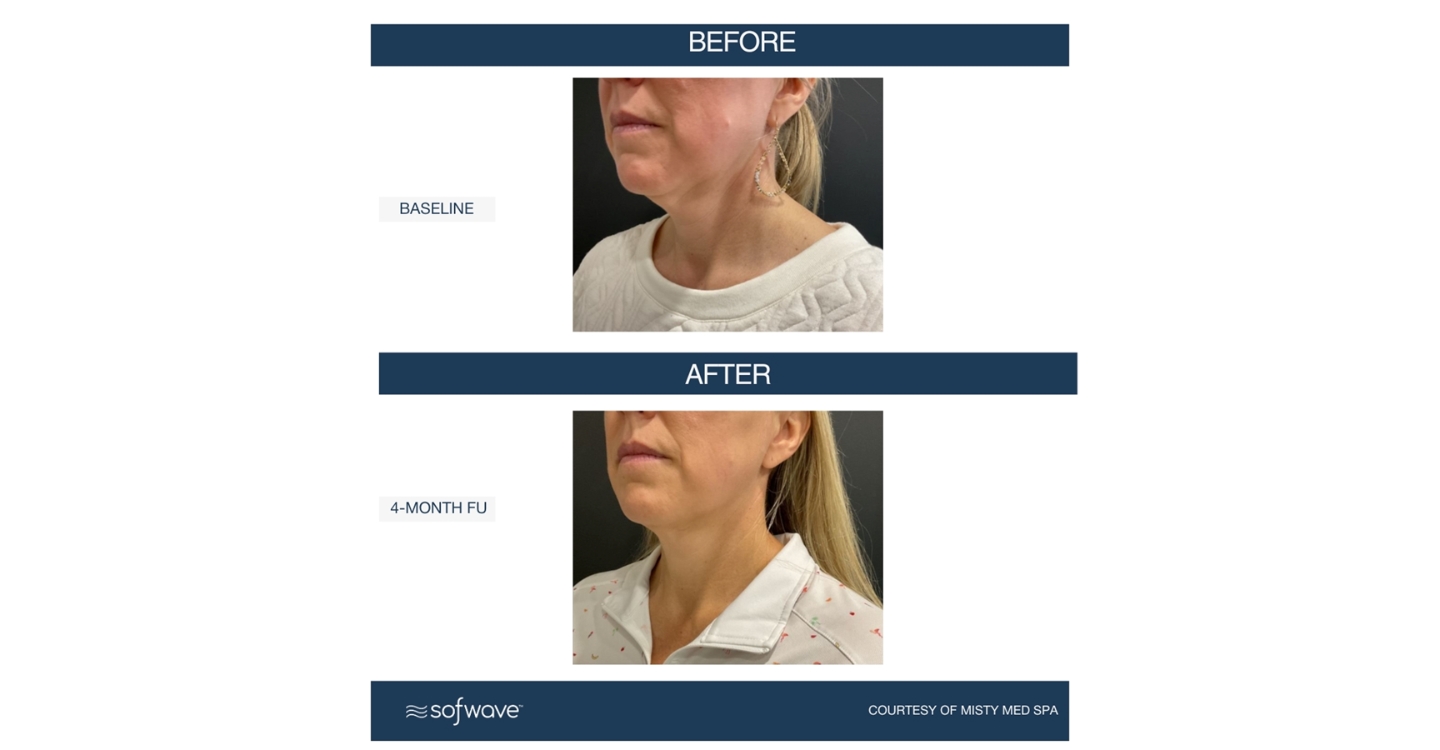 Before & After set - Sofwave submental and neck treatment